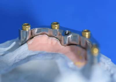Barre usinée sur implant et attachement locator