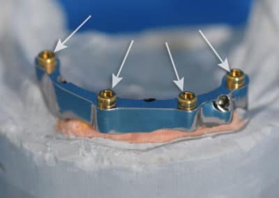 Barre usinée sur implant et attachement locator